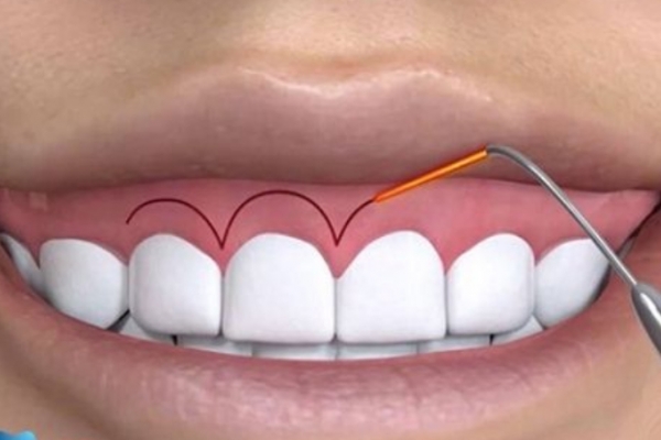 Dental crown lengthening surgery